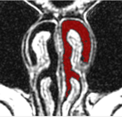 MRI of nasal airway showing segmentation