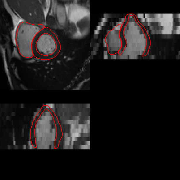 A cardiac MR image at ED