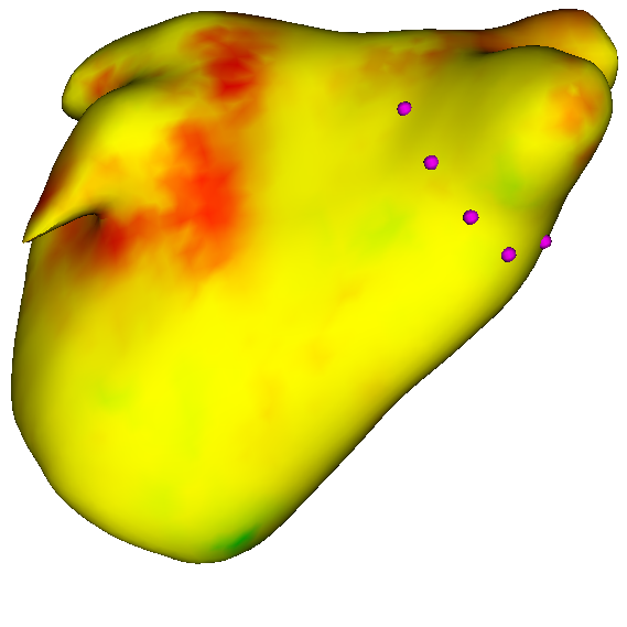 left atrium 3D render showing scar