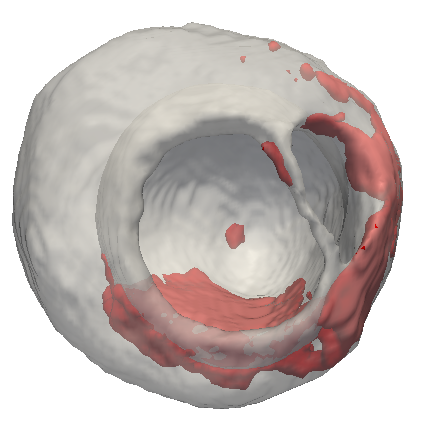 left ventricle 3D render showing scar