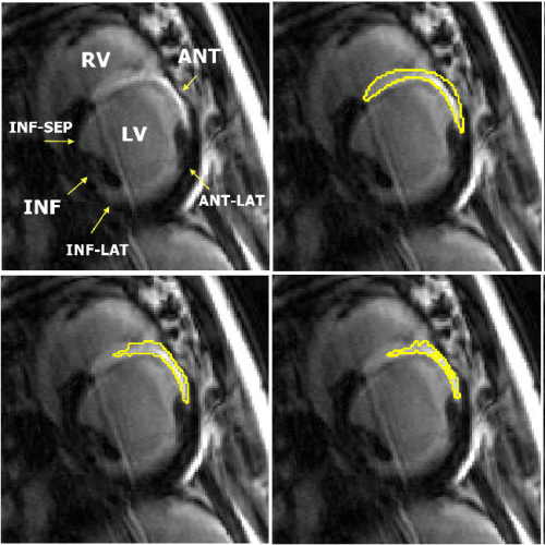 left ventricle de-mri sample